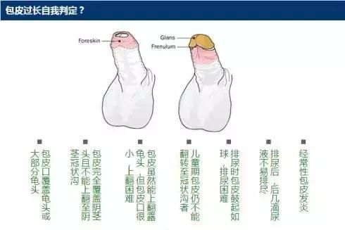 包皮到底要不要割？先搞懂這8個(gè)問題！